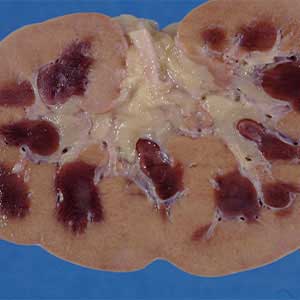 acute kidney disease