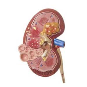 End stage renal disease treatment