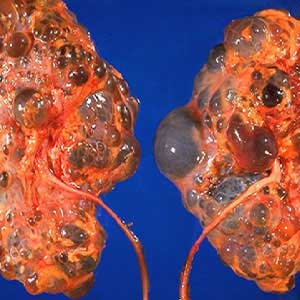 Polycystic kidney disease Treatment in vijayawada