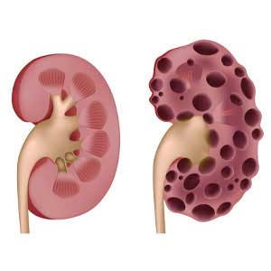 kidney cycts treatment in vijayawada